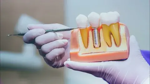 How to Care for Dental Implants After Surgery