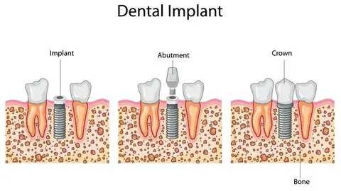 Dental implant 