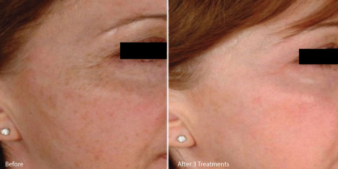 microneedle-los-angeles-before-and-after.jpeg