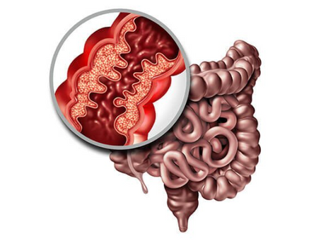 Doenças Inflamatórias Intestinais: O Que Você Precisa Saber