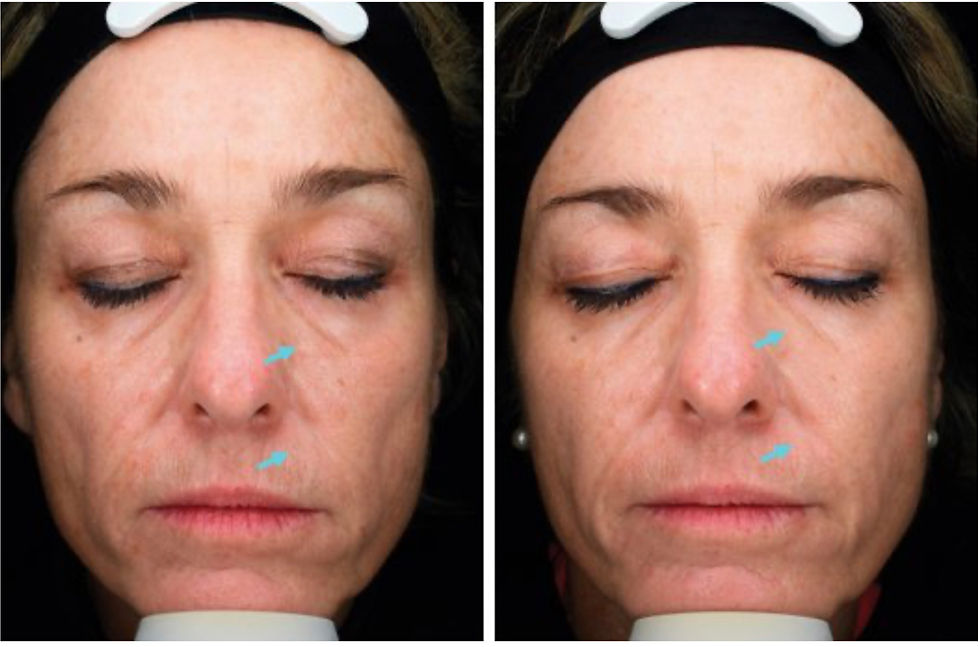mesopeel® jessner pro – 5 sessions