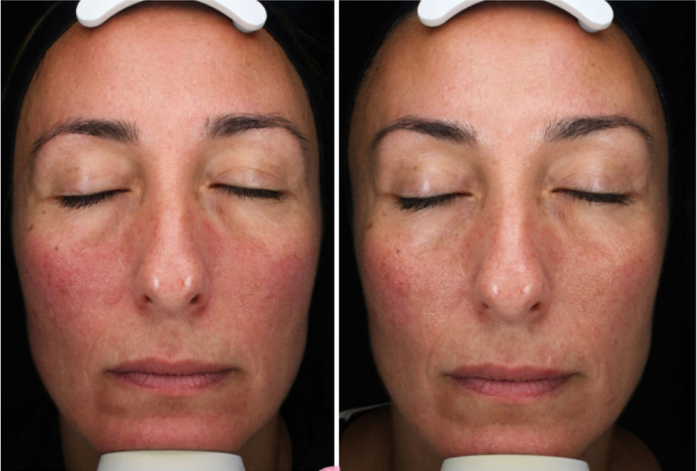 mesopeel® MD azelan rx – 4 sessions