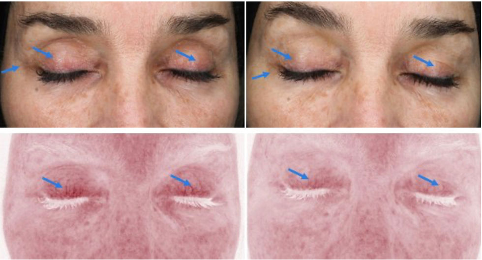 mesopeel® eyecon – 1 session