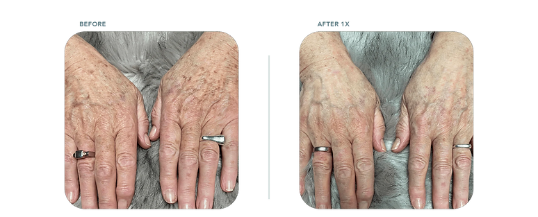 skin rejuvenation hands