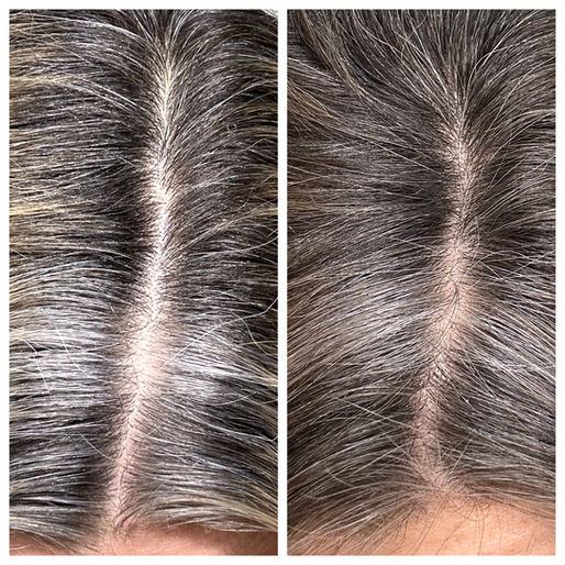 Hair Loss in Women: The Most Common Drivers