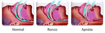 Ronco e apnéia