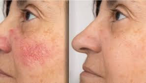 thread veins Lumecca Hale Altrincham Cheshire