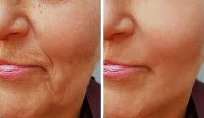 Botox vs Fillers: What Do You Actually Need?
