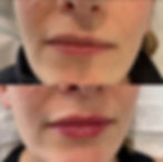 Lip Filler Hale Altrincham Cheshire Botox