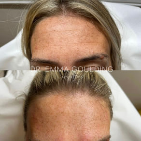 Botox: The 5 Most Commonly Asked Questions Answered