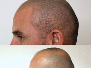 Hairline Tattoo Male: A Comprehensive Guide to Restoring Confidence and Style