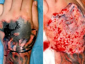 tattoo infection signs