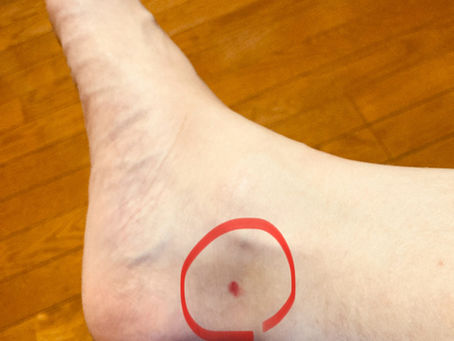 冷え、加齢に伴う諸症状の改善に効果的な【太谿】穴