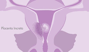 Causes Du Placenta Accreta