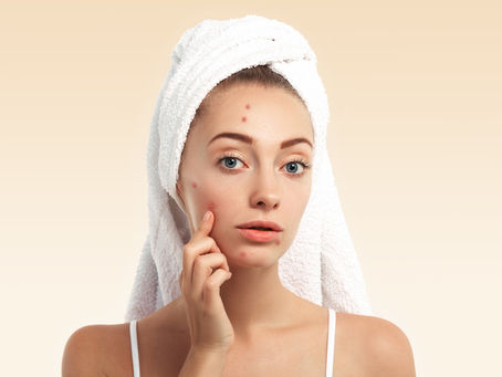 Say Goodbye to Scars: My Experience with Pimple Scar Removal in Singapore