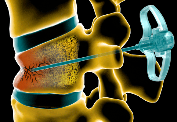 vertebroplastia.gif