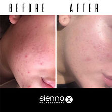 before-after-retinol-serum-katie.jpg