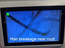 200x scalp zoom