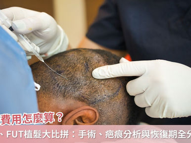 植髮費用怎麼算?FUE、FUT植髮大比拼:手術比較、疤痕分析與恢復期全分析