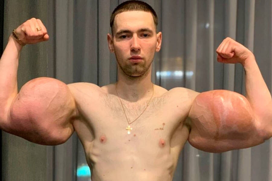 Kirill Tereshin hoped injecting the petroleum jelly would help him during his time in the military and his MMA career