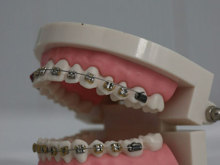 Top 5 Braces Options for Adults: Which One is Right for You