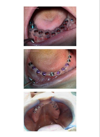 Implant, implant dentaire, implantologie guidée, implantologie numérique