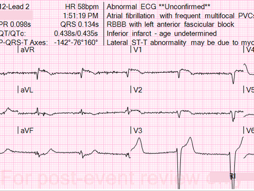 Hypertrophic Cardiomyopathy