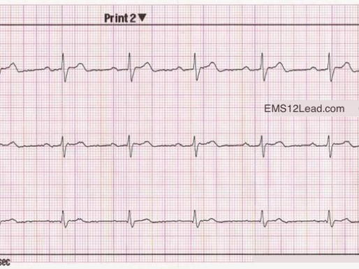 From The Vault: RBBB
