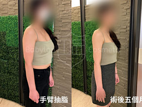 手臂抽脂