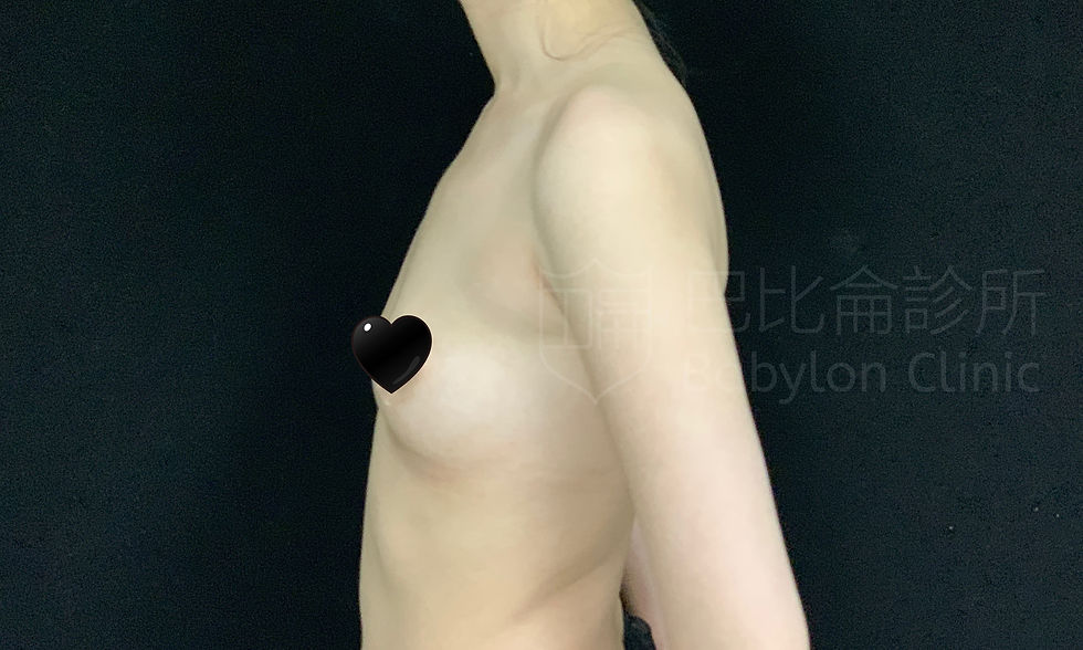 自體脂肪隆乳術前