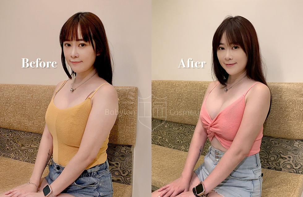 手臂腋下副乳抽脂 術後生活照