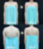 手臂腋下副乳抽脂