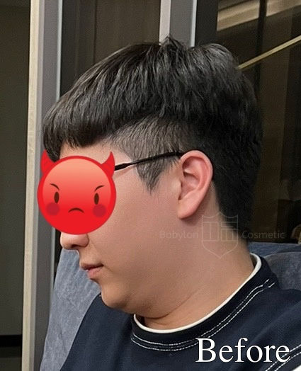 下巴輪廓線抽脂