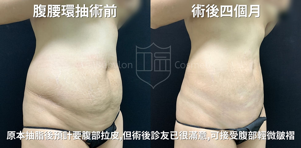 腹腰環抽術後正側面45度照,原本打算做腹部拉皮,但診友以很滿意可接受輕微皺褶與凹凸不平