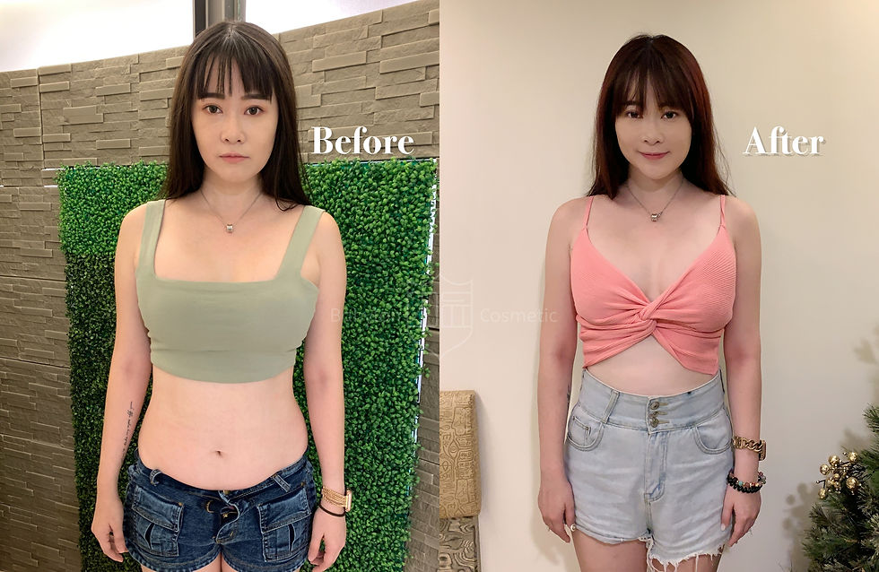 腹腰抽脂後 手臂抽脂後