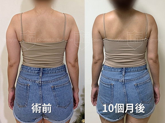 手臂後腋下抽脂