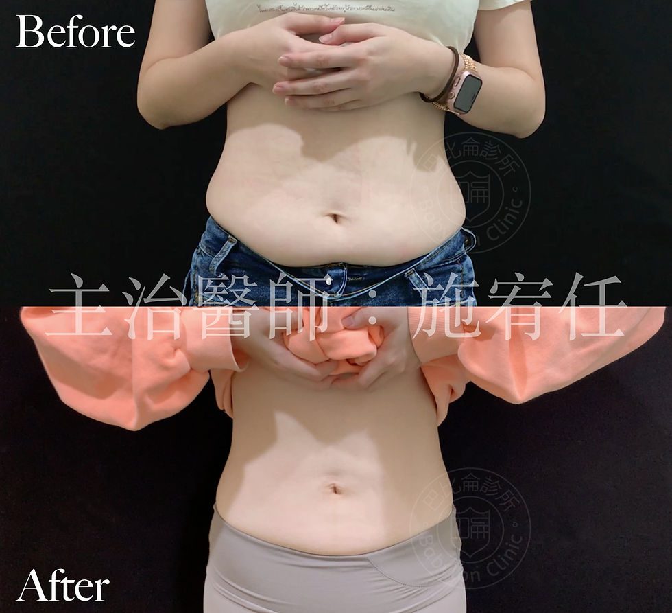 腹腰環抽 腹腰抽脂 剷除肥油