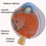 DISTACCO DI RETINA
