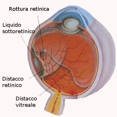 distacco retina3.jpeg