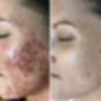 MyDMK_Branded_Before and After Imagery__DMKskin_LR_Scarring_2