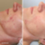 MyDMK_Branded_Before and After Imagery__DMKskin_LR_Scarring_7