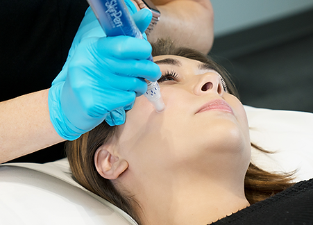 skinpen-microneedling-.png