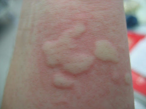 Urticaria en Tampico