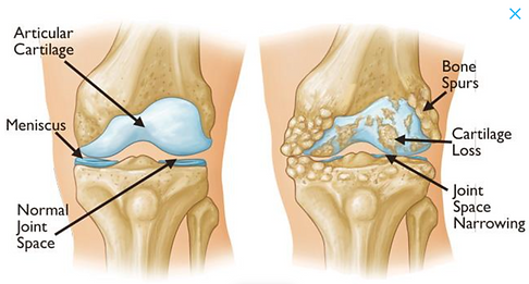 knee osteoarthritis.png