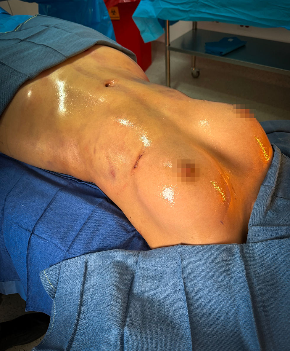 Vista frontal de una paciente antes y después de un Mommy Makeover realizado por el Dr. Ronald Espinoza