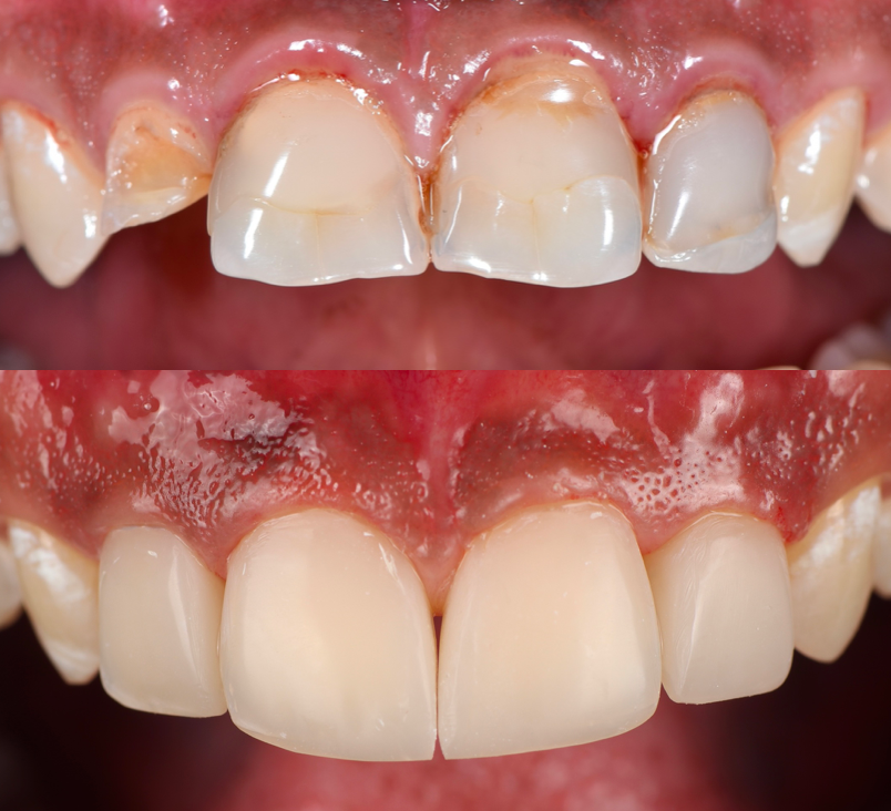 ابتسامة تجميلية بالحشوات المركبة قبل وبعد — د. يحيى سهلي طبيب أسنان تجميلي جازان