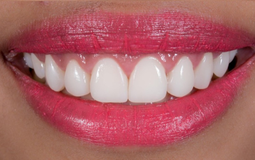 عدسات مينا لطب الأسنان.jpg