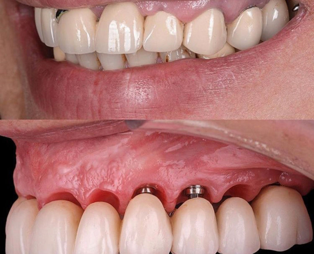 قبل وبعد تأهيل كامل للفكين بالزراعة — د. هيثم فقيه — جازان