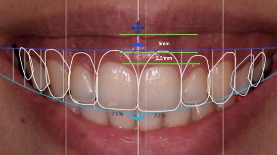 الإبتسامة اللثويه مركز مينا لطب الأسنان السعودية