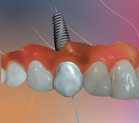 زراعة الأسنان في جازان